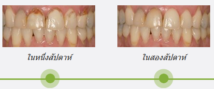 Dental Seal